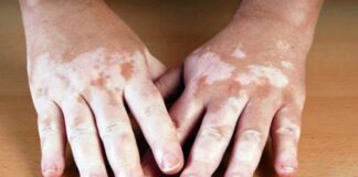 VITÍLIGO: UNA PATOLOGÍA DE LA PIEL QUE VA MÁS ALLÁ DE LA ESTÉTICA