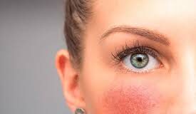 ROSACEA: SINTOMAS, PREVENCIÓN Y TRATAMIENTOS