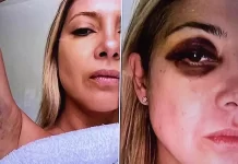 LAS FOTOS DE FABIOLA YAÑEZ GOLPEADA Y SUS MENSAJES CON FERNÁNDEZ: “TODO EL TIEMPO ME GOLPEÁS”