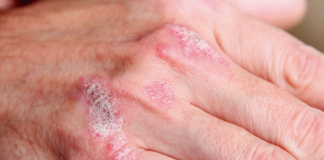 TODO LO QUE NECESITAS SABER SOBRE LA PSORIASIS