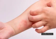 DERMATITIS ATÓPICA: LA ENFERMEDAD DE LA PIEL QUE AFECTA EL SUEÑO Y LA CALIDAD DE VIDA