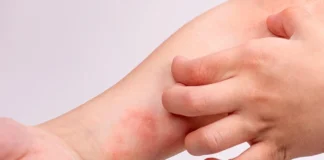 DERMATITIS ATÓPICA: LA ENFERMEDAD DE LA PIEL QUE AFECTA EL SUEÑO Y LA CALIDAD DE VIDA